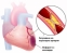Симптоми на инфаркт при жени над 50 годишна възраст