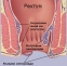 Хемороиди (Маясъл)