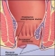 Хемороидален пролапс – обобщена информация за заболяването