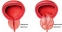 Още информация за симптомите при рак на простатата