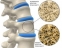 Остеопороза - научете повече за причините, симптомите и лечението на заболяването