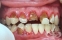 Връзка между гниене на зъбите и сърдечните заболявания