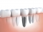 Зъбните импланти през годините