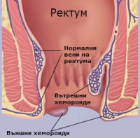 Хемороиди (Маясъл)