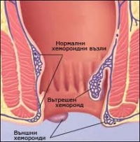 Хемороидален пролапс – обобщена информация за заболяването