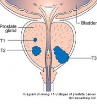 Какъв е процента на успешно лечение на рак на простатата?