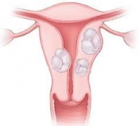 Миома – симптоми, видове и лечение на маточни тумори