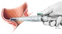 Неоперативни методи за лечение на вътрешни хемороиди