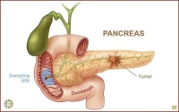 Откриха лекарство срещу рак на панкреаса!